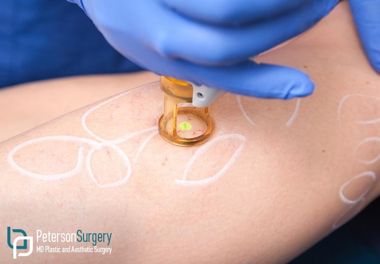 Peterson MD V Beam Treatment for Spider Veins