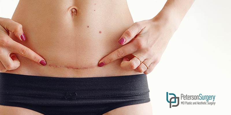 What is a Scar Revision? | Kelowna Plastic Surgery Clinic