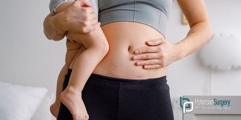 Mommy Makeover Benefits: Revitalize Post-Pregnancy