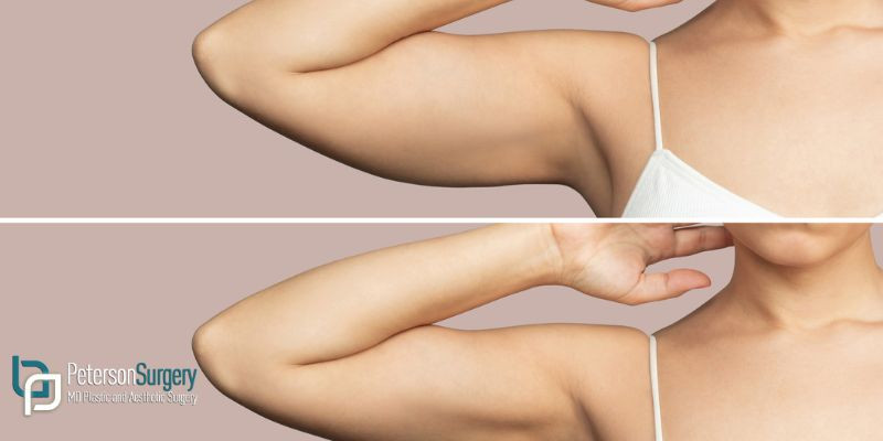 Armpit fat before and after Brachioplasty, liposuction or plastic