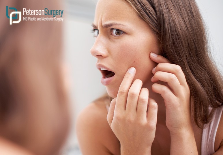 Acne Scars Should Not Follow You Into Adulthood 