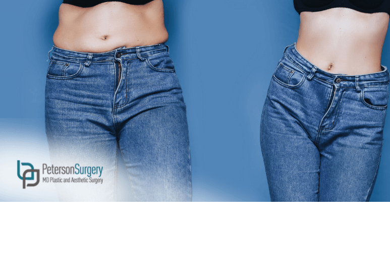 PetersonMD | Blog | Body Contouring: Tummy Tuck Or Liposuction? Which Should I Consider?