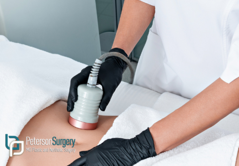 Achieve Your Dream Shape with Body Contouring in Kelowna 