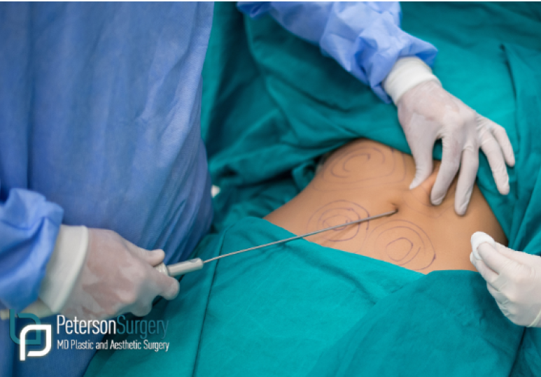  How Liposuction in Kelowna Can Support Your Body Contouring Goals 