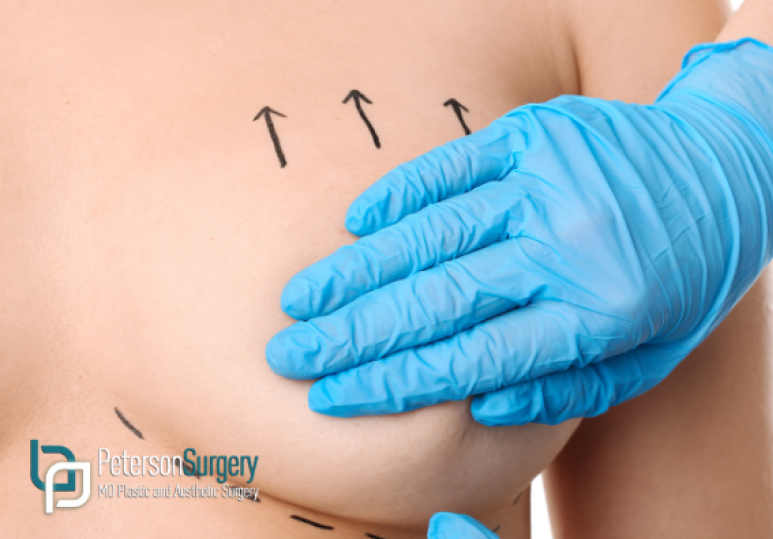 Breast Lift in Kelowna: What to Expect Before, During, and After Surgery