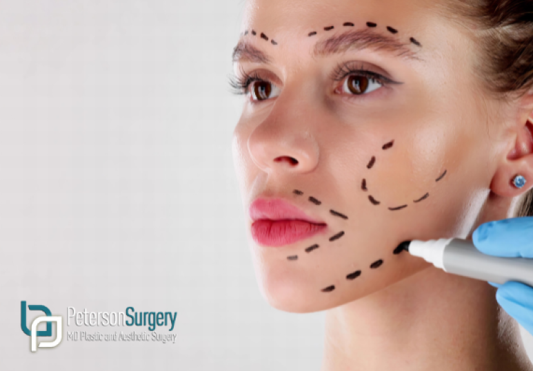 Facelifts for Younger Patients Why Mini Lifts Are Trending