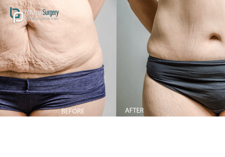 Tummy Tuck Recovery Timeline: What to Expect Week by Week