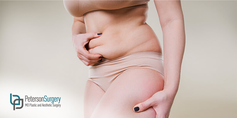 Having a Tummy Tuck: What You Need to Know