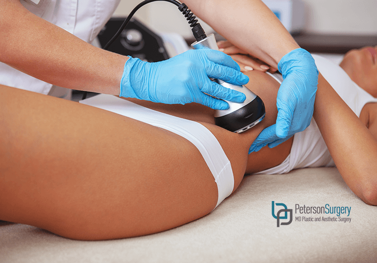 3 Popular Body Contouring Procedures in Kelowna