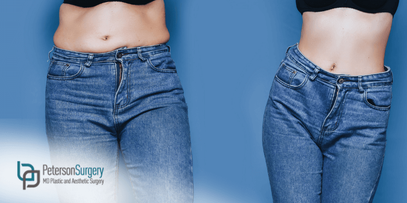 Abdominal Liposuction  Stomach, Belly, Tummy Lipo Procedures