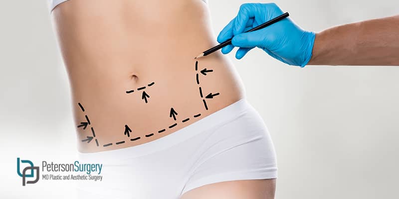 Things You Should Consider Before Having A Tummy Tuck