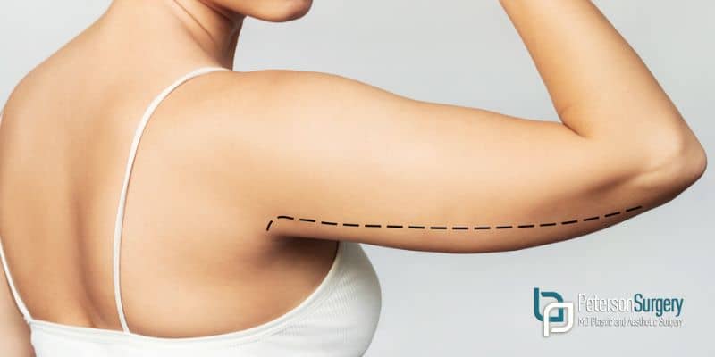 Body Contouring: Recovery After Arm Lift Surgery