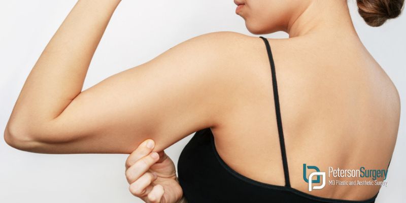 The 3 Questions Everyone Asks About Arm Lift Aftercare