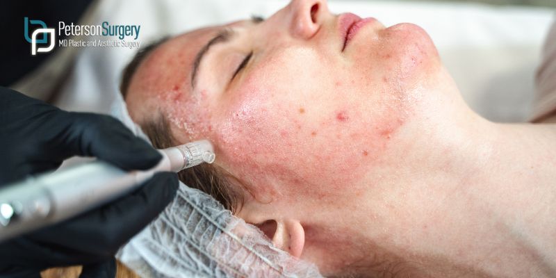 Banish Acne Woes: Your Guide to Effective Acne Treatments
