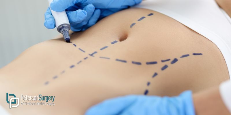 Tummy Tuck Essentials with Dr. Peterson
