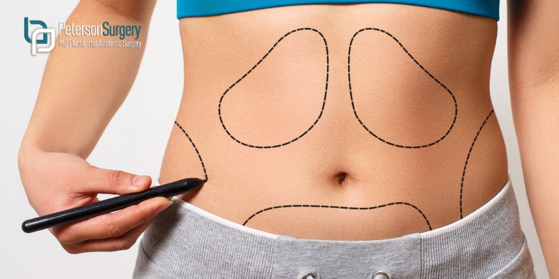 Top 5 Aesthetic Surgery Procedures in the Okanagan