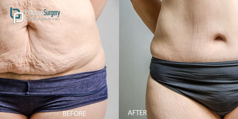 Tummy Tuck vs. Liposuction: Which Procedure Is Best for You?