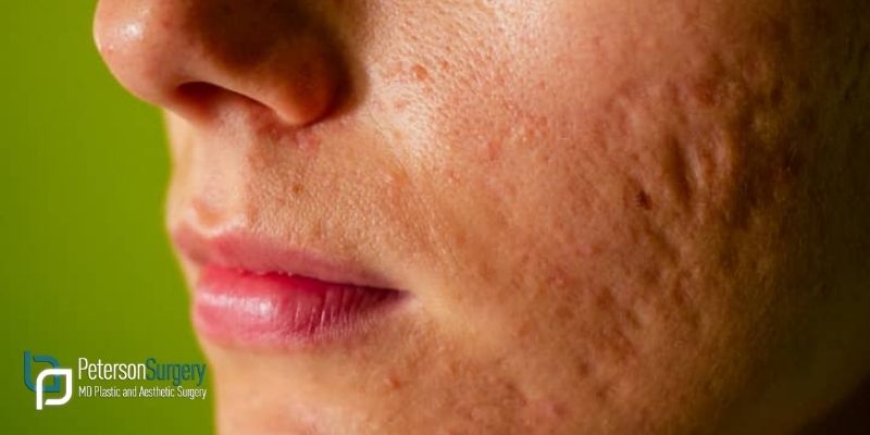 How Dermabrasion Helps Treat Acne Scars: Transforming Your Skin