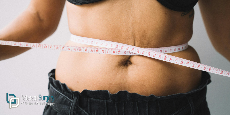 Everything You Need to Know About Tummy Tucks in Kelowna 