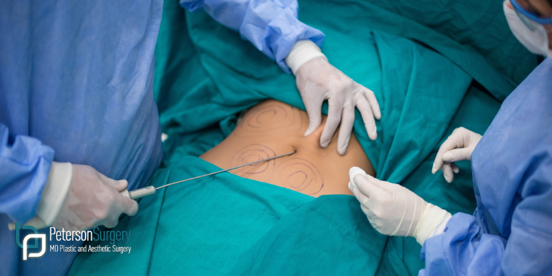  How Liposuction in Kelowna Can Support Your Body Contouring Goals 