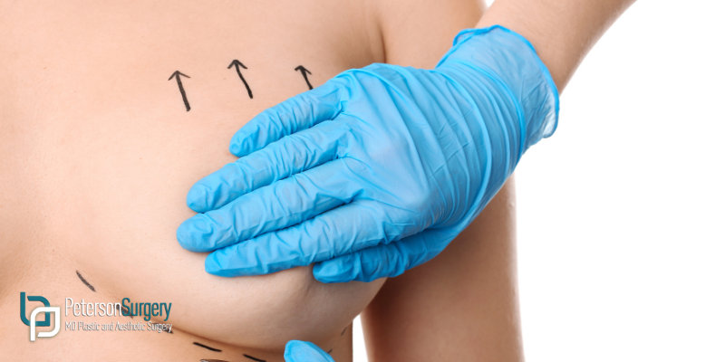Breast Lift in Kelowna: What to Expect Before, During, and After Surgery