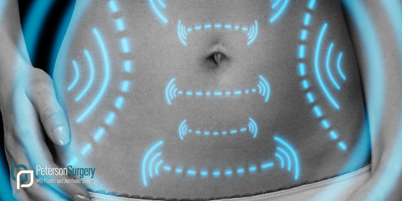 Understanding Liposuction: Contour, Combine, and Transform