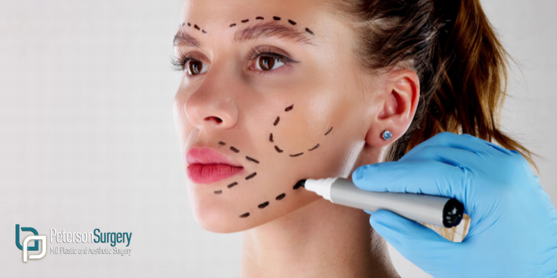 Facelifts for Younger Patients Why Mini Lifts Are Trending