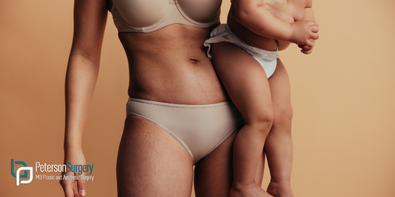 What Is a Mommy Makeover? Combining Procedures for Transformative Results