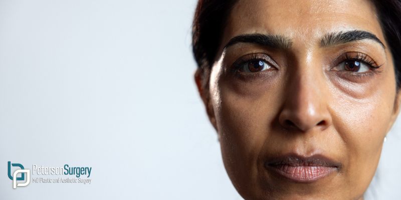 Blepharoplasty vs Eyelid Surgery: Are They the Same Procedure Overall?