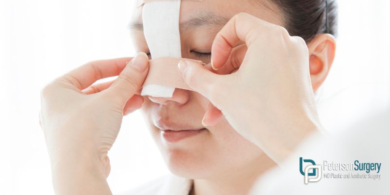 Rhinoplasty Recovery Timeline: What to Expect After Cosmetic Nose Surgery