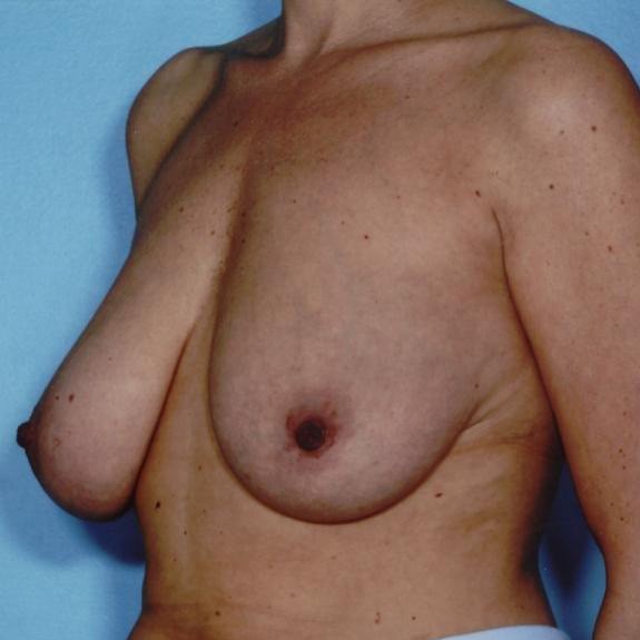 Breast lift with own tissue augmentation, auto-augmentation breast lift