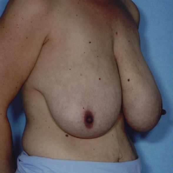Breast lift with own tissue augmentation, auto-augmentation breast lift